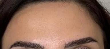 Forehead Smoothing — after treatment