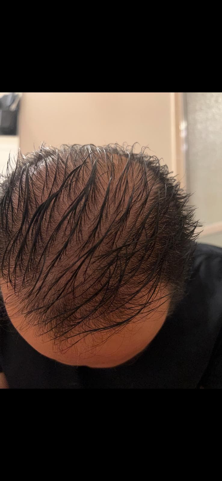 Hair Restoration — before treatment