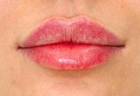 Lip Enhancement — after treatment