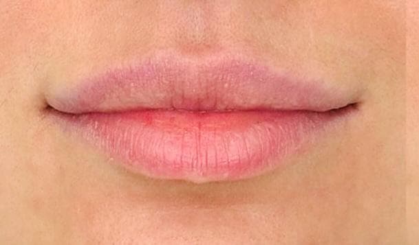 Lip Enhancement — before treatment